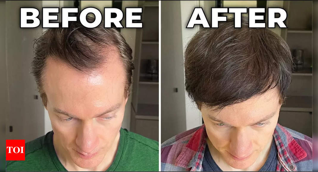 Millionaire Bryan Johnson reveals how he hacked genetic baldness and premature hair greying